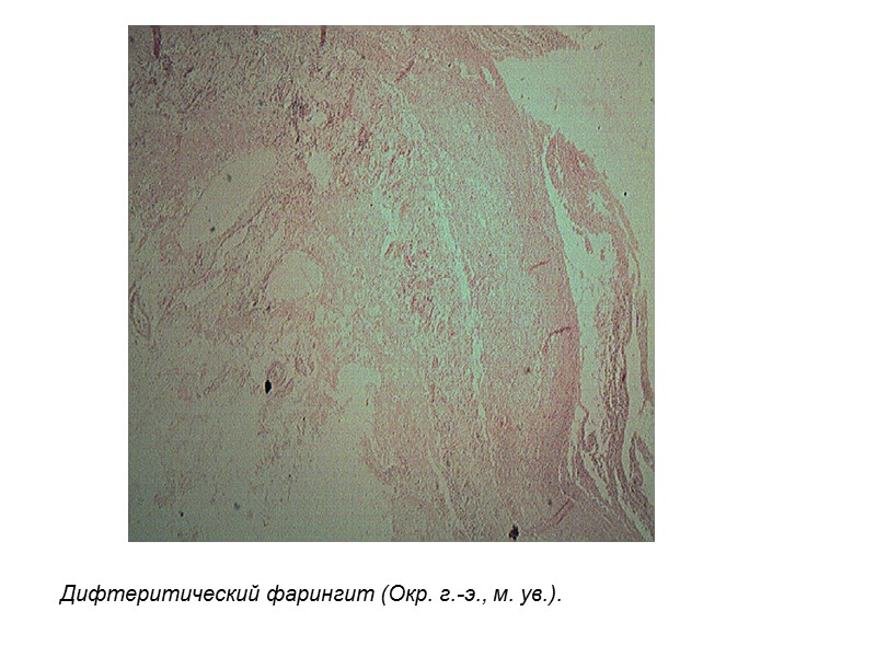 Дифтеритический фарингит (Окр. г.-э., м. ув.).